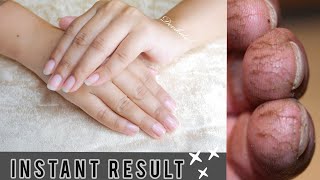 How to get rid of Cracked, Dry, Peeled fingers|| Overnight Healing Remedy Must try!