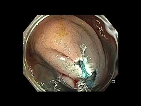 Kolonoskopia: mukozektomia endoskopowa (EMR) guza LST-NG zlokalizowanego w kątnicy