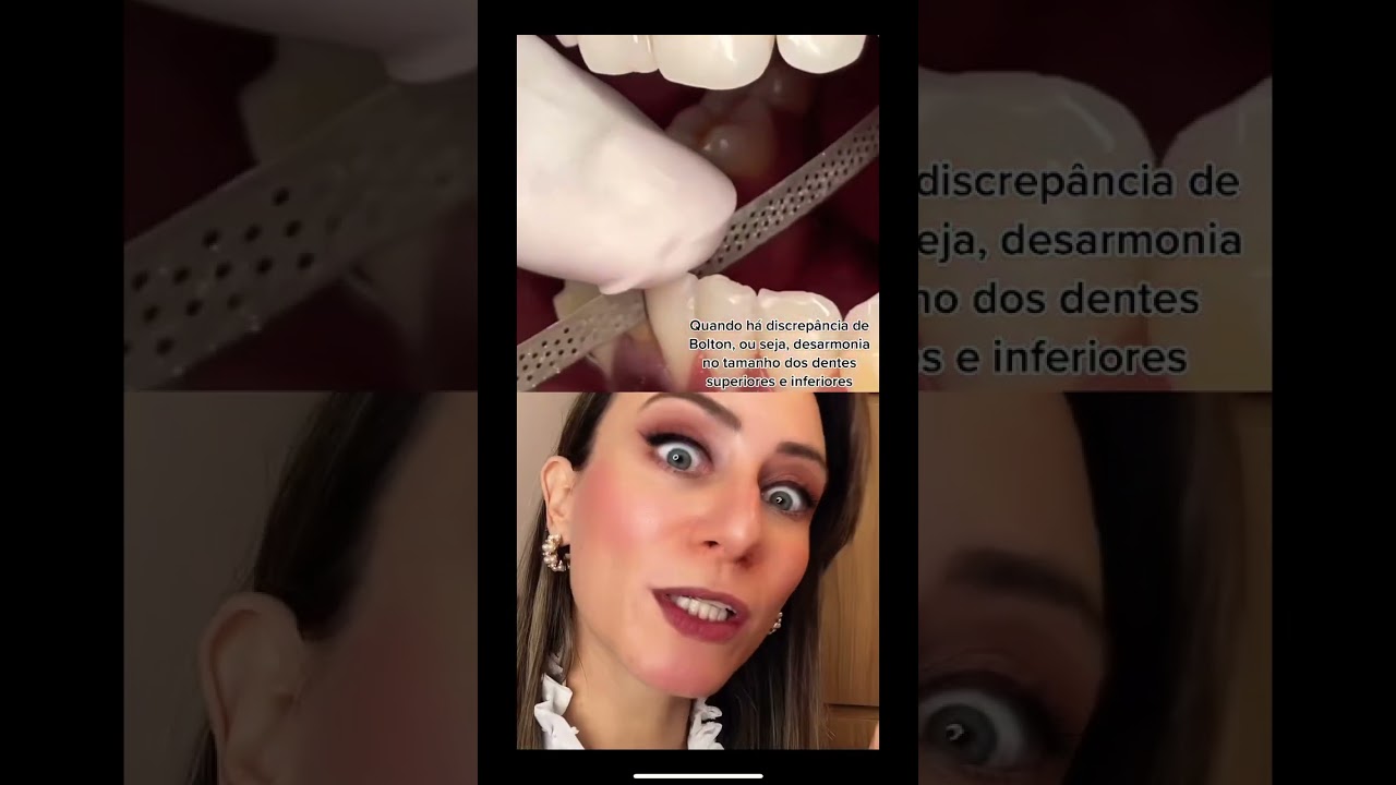 Você imaginava que essa lixa tinha essa finalidade???? #aparelhoortodôntico #dente