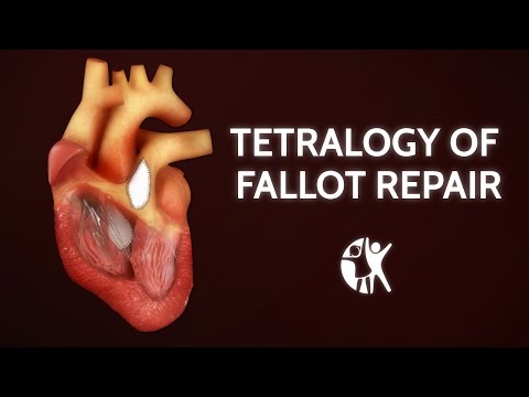 Tetralogy of Fallot Repair | Cincinnati Children's