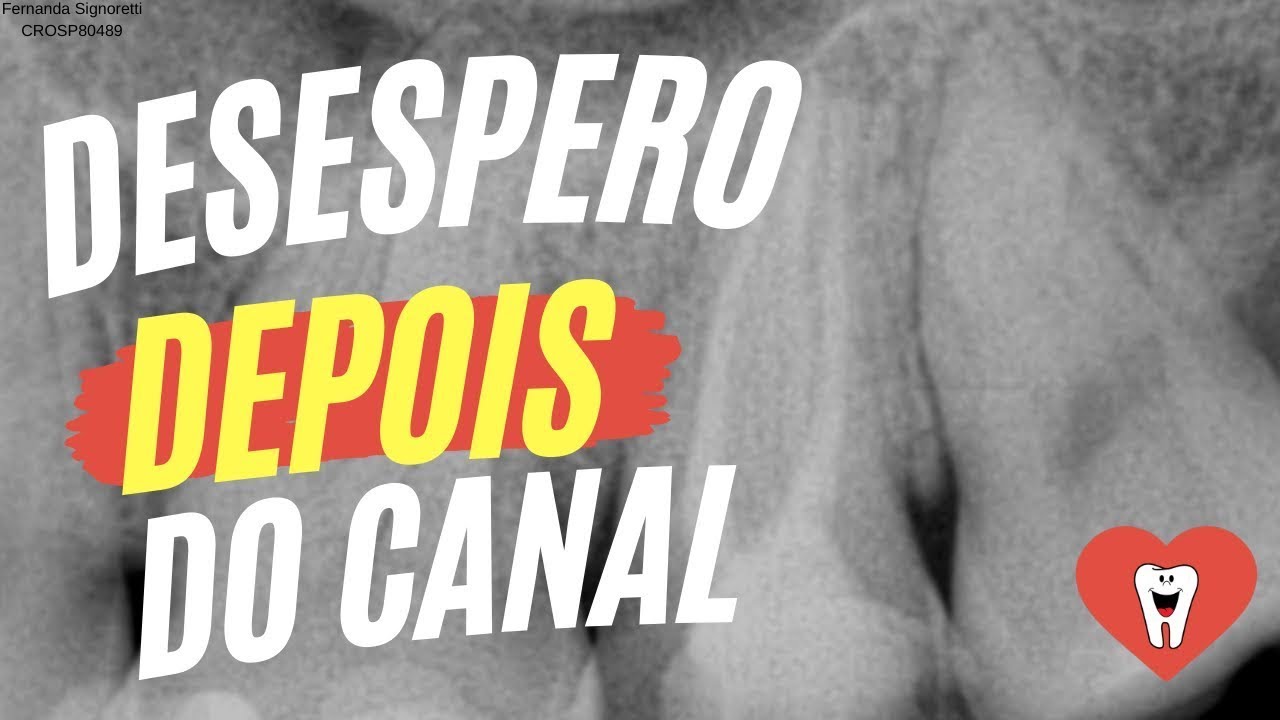 DOR FORTE APÓS FAZER CANAL? COMO ALIVIAR - Endolovers