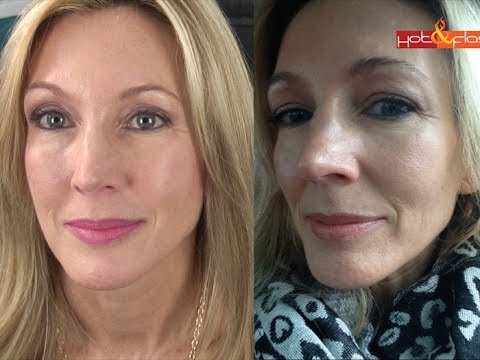 My Experience With Botox & Filler (Juvederm) Video