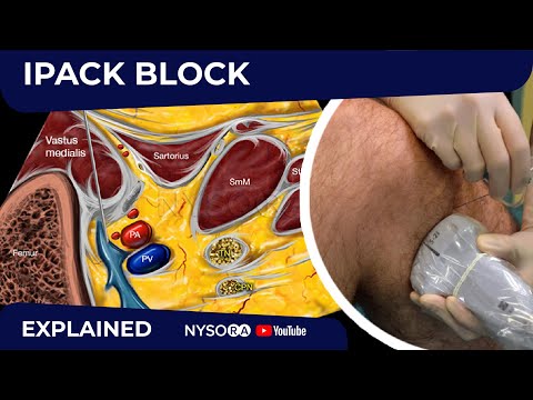 IPACK Block - Regional anesthesia Crash course with Dr. Hadzic