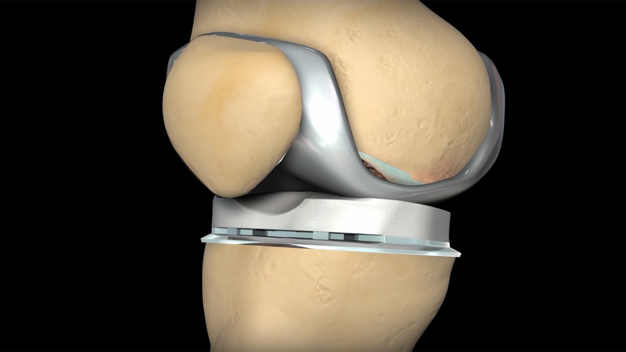 Orthopedic Practice Marketing Video That Educates Patients & Grows Referrals