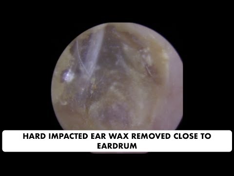 HARD IMPACTED EAR WAX REMOVAL CLOSE TO EARDRUM - Ep 25