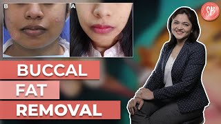 Buccal Fat Removal Surgery, Recovery & Results | Face or Cheek Fat Removal | Dr. Shilpi Bhadani