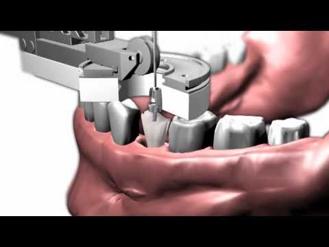 Stomatochirurgie umí trhat zuby šetrně bez kleští. A také je recykluje, vytažený zub už není odpad | Hradec Králové