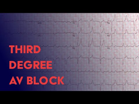 Third Degree (Complete) Heart Block -  EKG (ECG) Interpretation