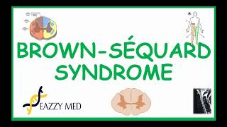 Brown-Sequard Syndrome causes, pathophysiology, symptoms diagnosis and treatment