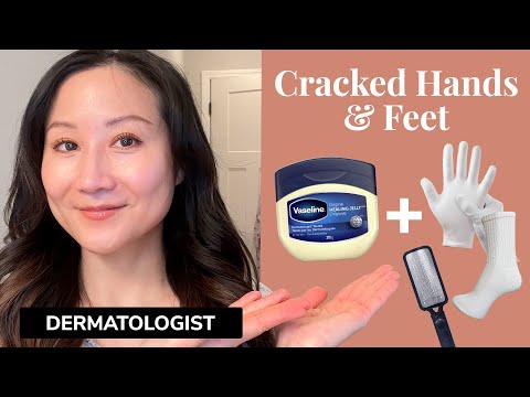Heal Dry & Cracked Hands & Feet with This Quick Dermatologist Tip