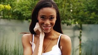 How a Model with Vitiligo Ignored Bullies and Became an Inspiration to All