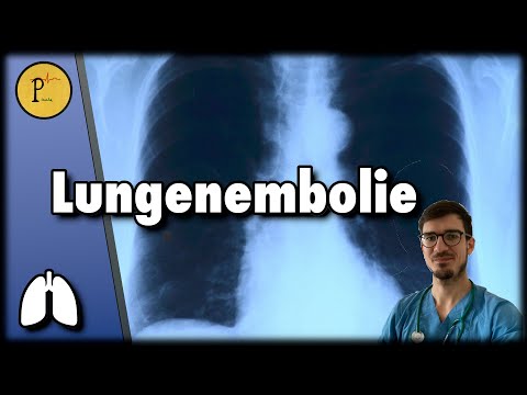 Pulmonary embolism explained. When you suddenly run out of breath.