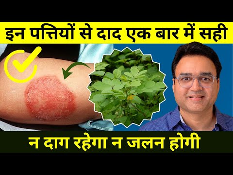 पुराने से पुराना दाद एक बार में हो जायेगा सही | Best Remedy For Fungal Skin Infection