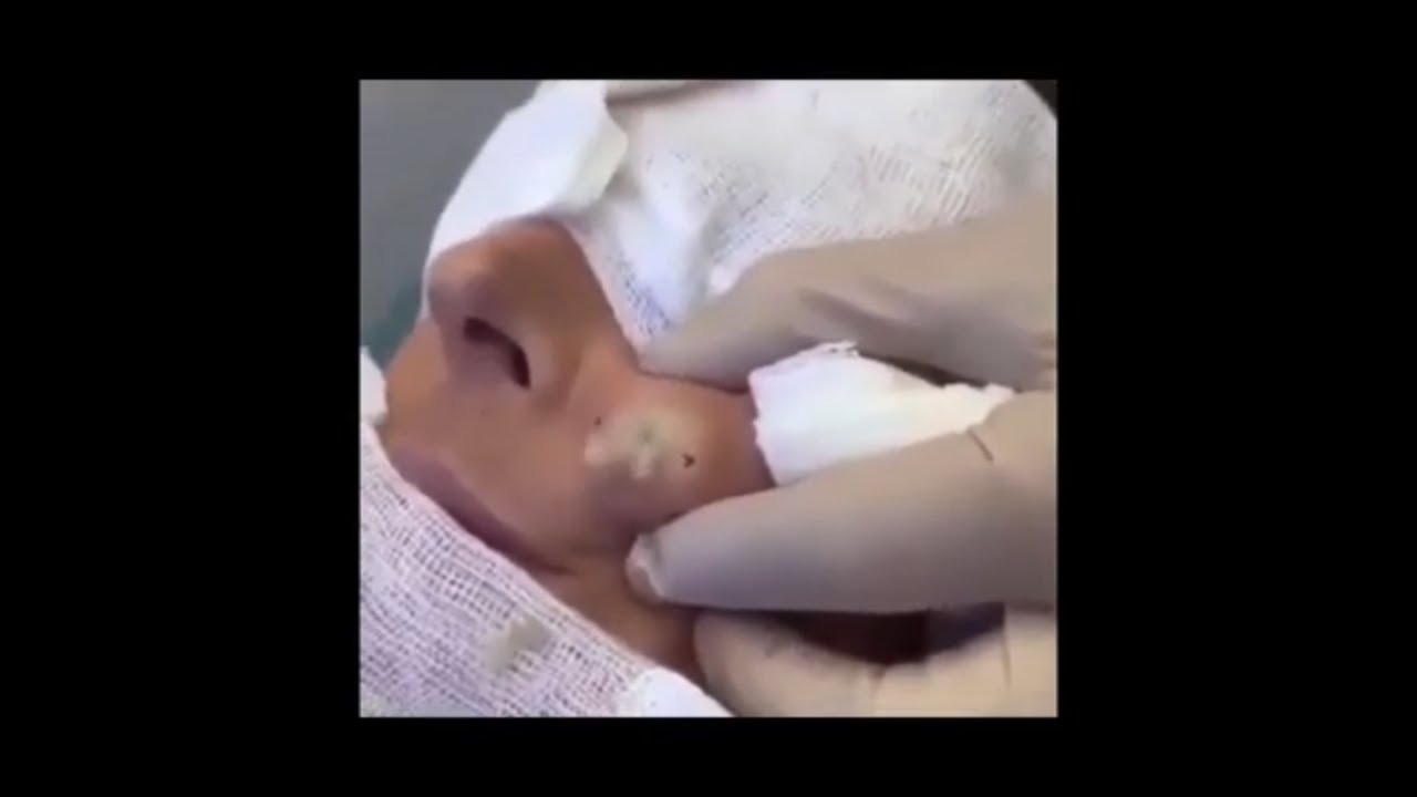 Brufolo pieno di pus