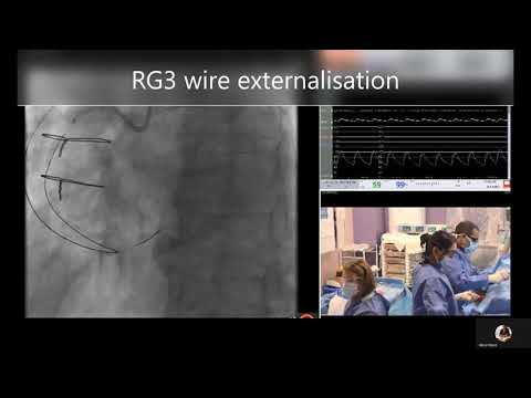Right coronary artery CTO treated with retrograde reverse CART and rotational atherectomy