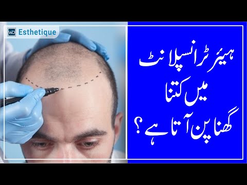 Unlock Maximum Hair Density – What’s Possible in One Transplant Session