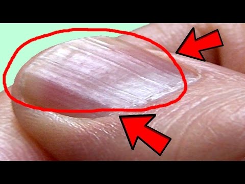 Kung saan upang bumili ng in Gomel ekzoderil Paggamot ng kuko halamang-singaw sa daliri ng katutubong remedyong