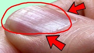 What Causes Ridges in Finger and Toenails
