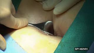 Hemorrhoidectomy Procedure with THUNDERBEAT OEJ - Olympus - Dr. Lane