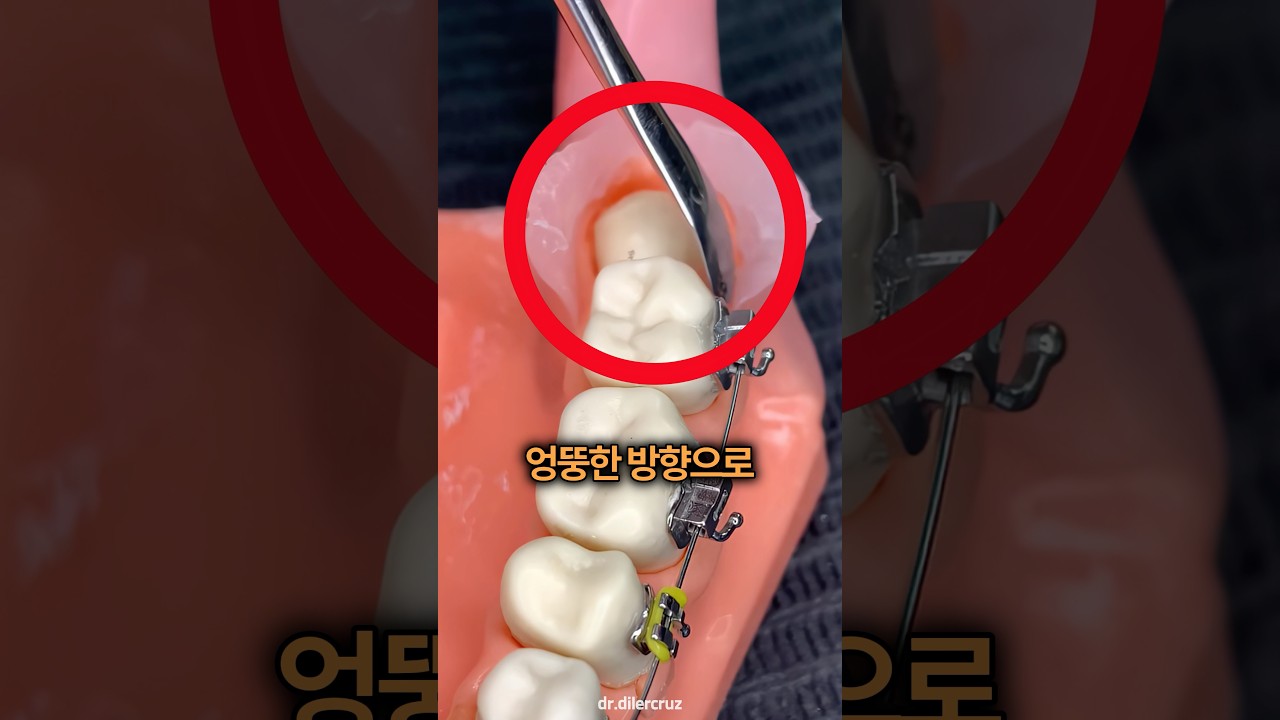 잇몸을 절개 했더니 나온 치아의 정체 🦷