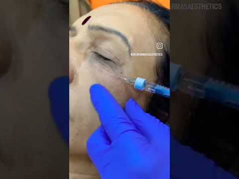 Dark circles under eyes treatment