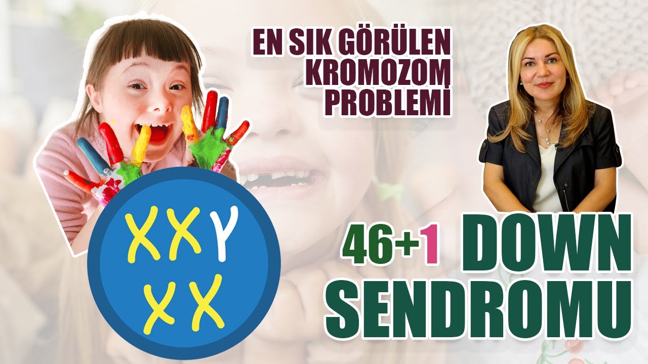 En Sık Görülen Kromozom Problemi : Down Sendromu (Mongolizm)