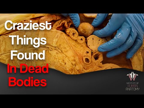 , title : '5 Craziest Things I've Found In Dead Bodies'