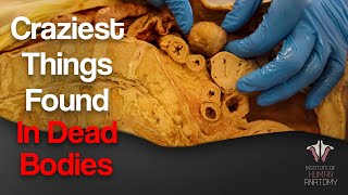 5 Craziest Things Ive Found In Dead Bodies