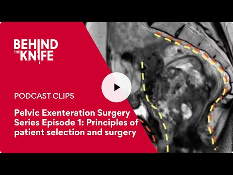 Pelvic Exenteration Surgery Series Episode 1: Principles of patient selection and surgery