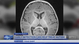 Dr. Campbell: Early Detection can help treat Autism in Babies