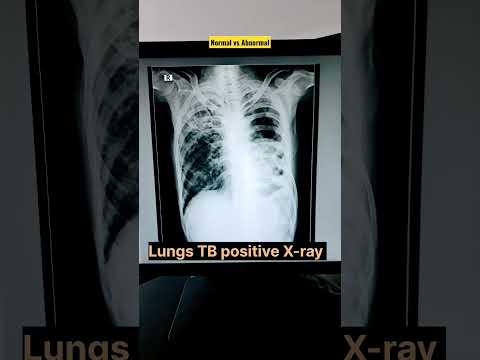 Chest X-ray Normal vs Abnormal  #shorts