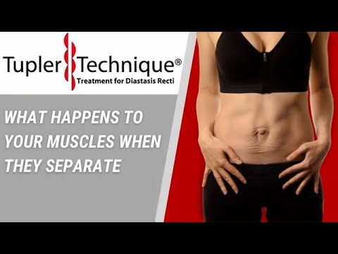 What happens when abdominal muscles separate