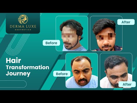 Scar Treatment (1 Session)