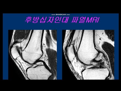 후방십자인대 파열MRI