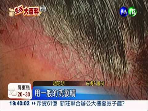 用錯洗髮精! 男大生1週掉髮千根