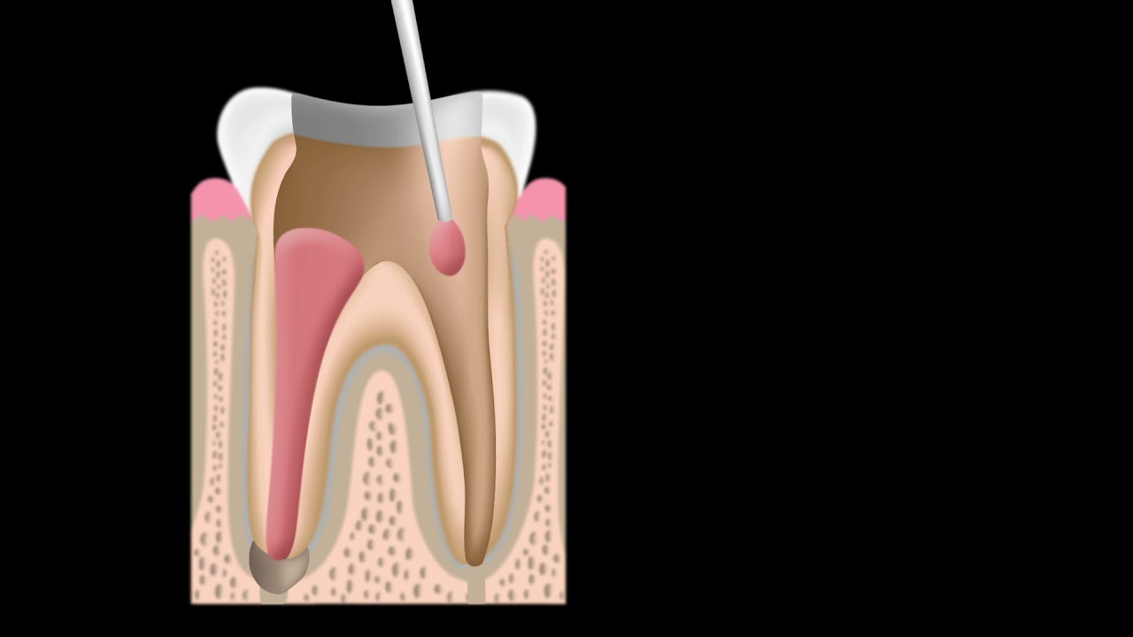 Root Canal Treatment NYC - Video