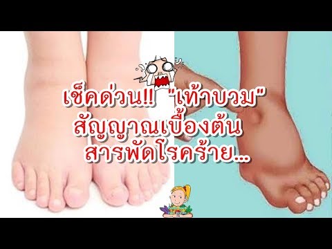 น้ำเย็นจากโรคสะเก็ดเงิน เด็กกลาก 1 ปี