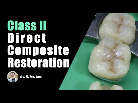 Class II Direct Composite Filling, Posterior Restoration