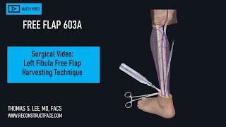 Surgery: Simplified Fibula Flap Harvesting: Guide for Beginner Flap Surgeons! [603A] Surgery