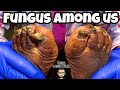 SUPER LARGE FUNGAL TOENAILS INCREDIBLE TRANSFORMATION