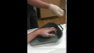 Massive Hand Blister Popped