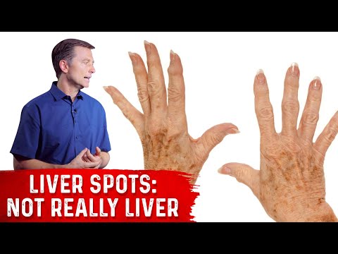 How Your Feet Are Warning You About Your Liver Problems Dr Berg Explains