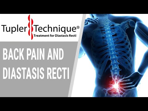 Back Pain and Diastasis Recti- Julie Tupler, RN