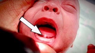 PREMMIE NEWBORN (With Unusual Tongue-Tie) |  Dr. Paul