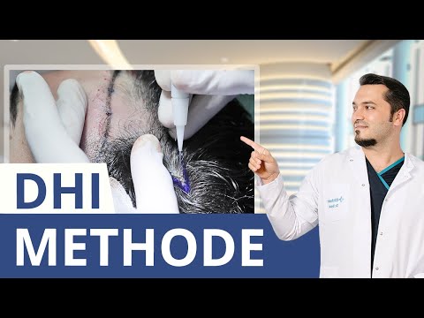 Was ist die DHI Haartransplantation? Dr. Balwi erklärt!