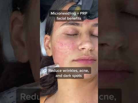 Top benefits of PRP Facial and Microneedling