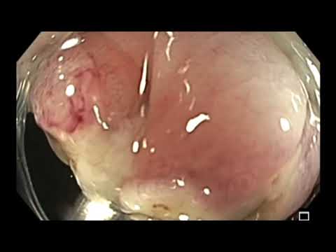 Resección de un pólipo del ángulo hepático del colon