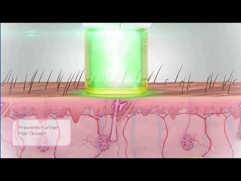 Gentle Laser Hair Removal Animation - Laser Hair...