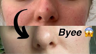 Laser Treatment for Facial Capillaries and Rosacea | Results? Cost?