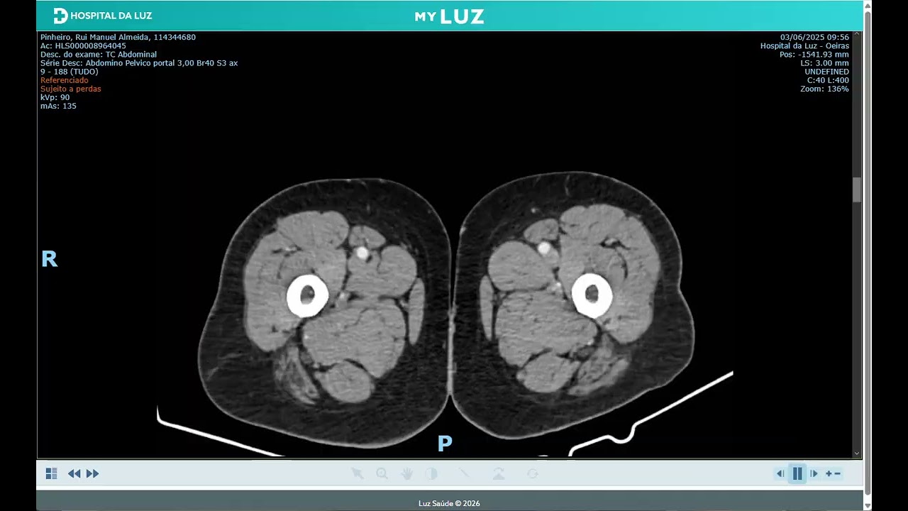 Pelvic CT Thumbnail